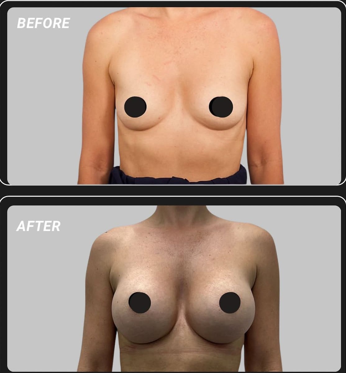 Breast Implant Before and After Result 3